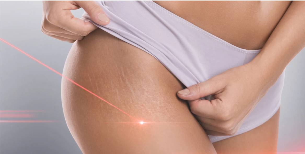 Plasma Blast-Stretch Mark Revision